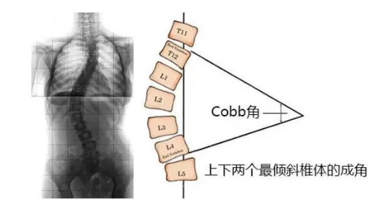 脊柱側(cè)彎角度怎么測(cè)量？